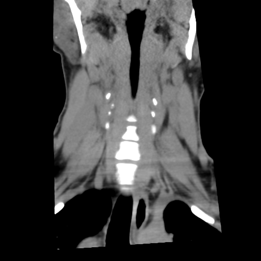 File:Cervical schwannoma (Radiopaedia 57979-64974 Coronal non-contrast 14).png
