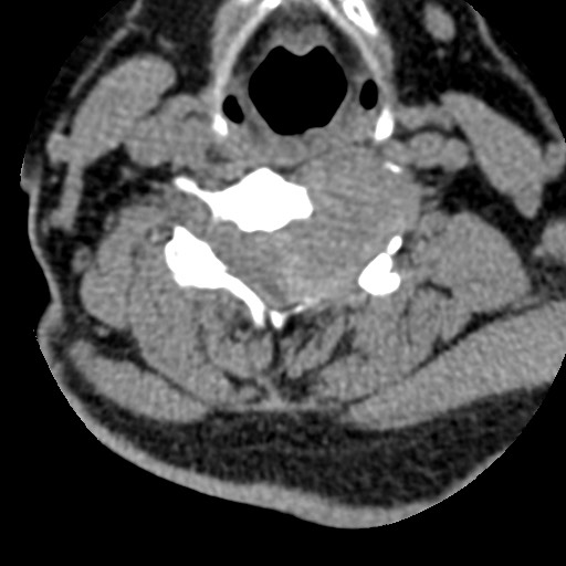 File:Cervical spinal neurofibroma in a patient with NF1 (Radiopaedia 58344-65464 Axial non-contrast 43).jpg