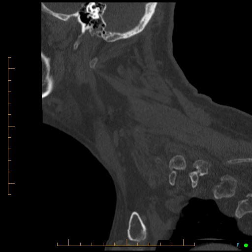 File:Cervical spine fracture - ankylosing spondylitis (Radiopaedia 76835-88706 Sagittal bone window 21).jpg