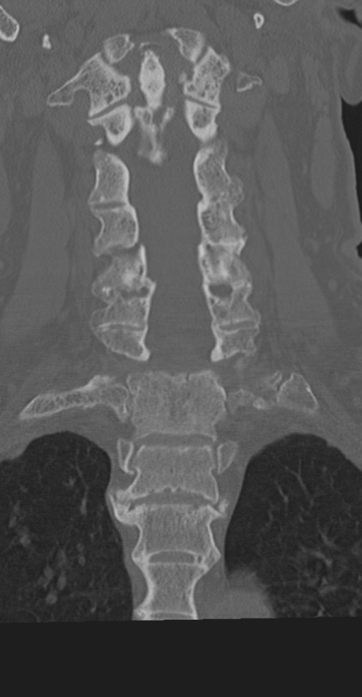 Cervical spine fracture in the setting of ankylosis (Radiopaedia 37038-38715 Coronal bone window 36).png