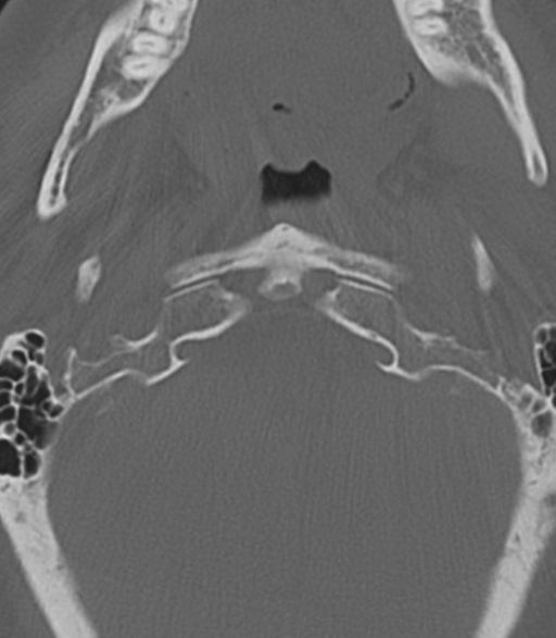 Cervical spine fractures with vertebral artery dissection (Radiopaedia 53296-59268 Axial bone window 9).png