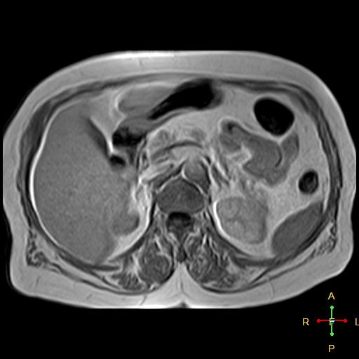 File:Cervical stump squamous cell carcinoma (Radiopaedia 48049-52858 H 6).jpg