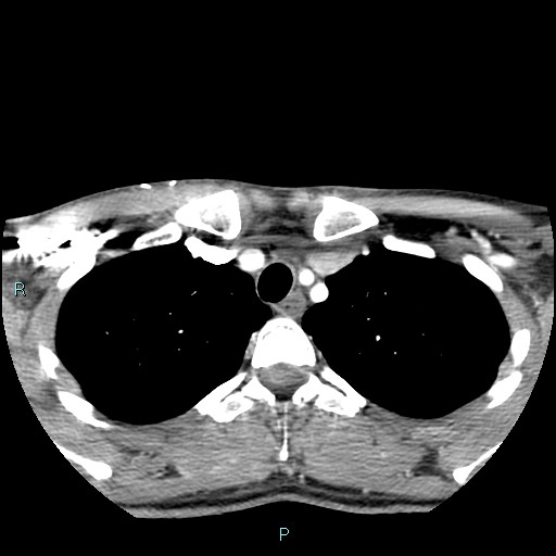 Cervical thymic cyst (Radiopaedia 88632-105335 B 17).jpg