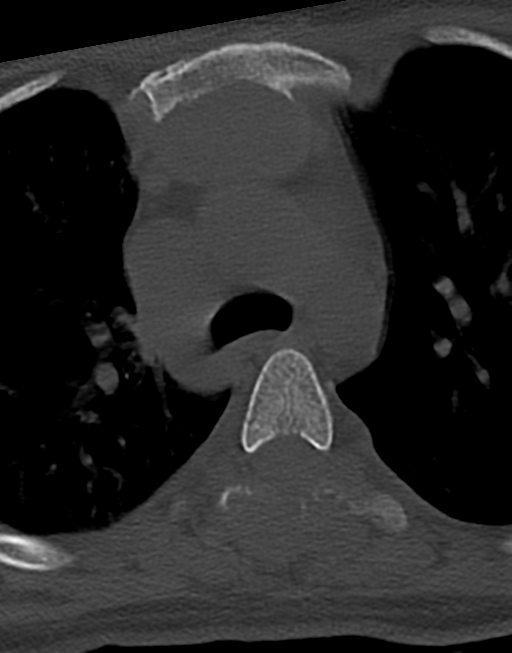 Cervical tuberculous spondylitis (Radiopaedia 39149-41365 Axial bone window 64).png