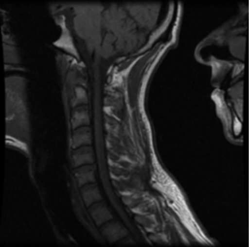 File:Cervical vertebrae metastasis (Radiopaedia 78814-91667 Sagittal T1 7).png