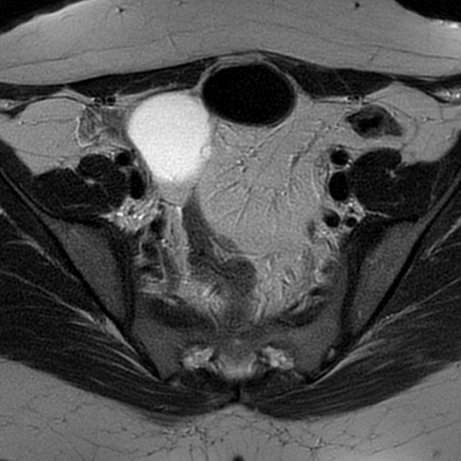 File:Cesarean scar ectopic pregnancy (Radiopaedia 77286-89362 Axial T2 15).jpg