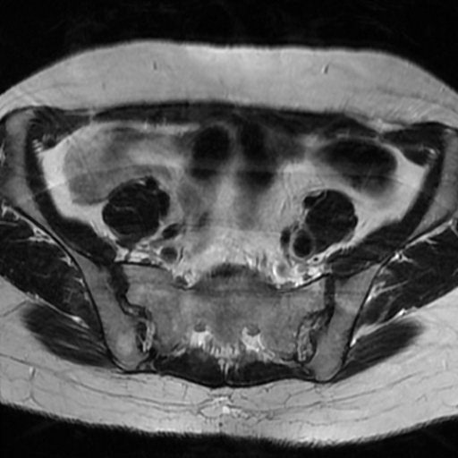 File:Cesarian section scar endometriosis (Radiopaedia 66520-75799 Axial T2 2).jpg