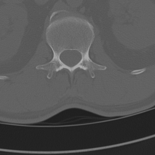 Chance fracture (Radiopaedia 33854-35020 Axial bone window 108).png