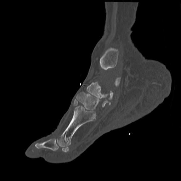 File:Charcot joint (Radiopaedia 36629-38194 Sagittal bone window 63).jpg