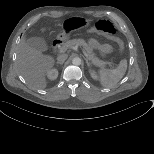 File:Chest multitrauma - aortic injury (Radiopaedia 34708-36147 A 303).png