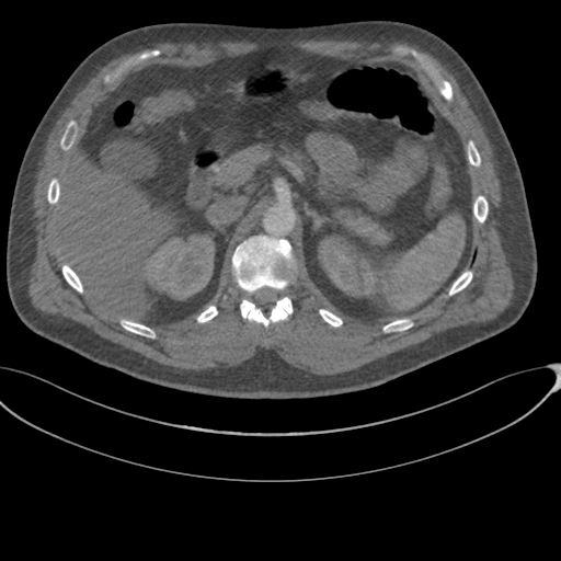 File:Chest multitrauma - aortic injury (Radiopaedia 34708-36147 A 313).png