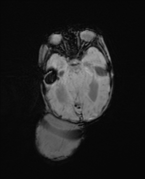 Chiari III malformation with occipital encephalocele (Radiopaedia 79446-92559 Axial SWI 31).jpg