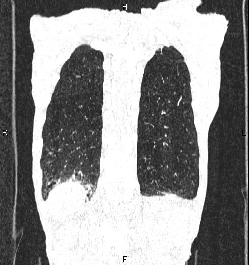 Chilaiditi sign (Radiopaedia 88839-105611 Coronal lung window 55).jpg
