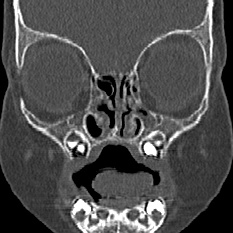 Choanal atresia (Radiopaedia 88525-105975 Coronal bone window 25).jpg
