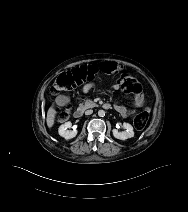 Cholangiocarcinoma with cerebral metastases (Radiopaedia 83519-98629 Axial C+ delayed 47).jpg