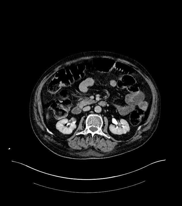 Cholangiocarcinoma with cerebral metastases (Radiopaedia 83519-98629 Axial C+ delayed 50).jpg