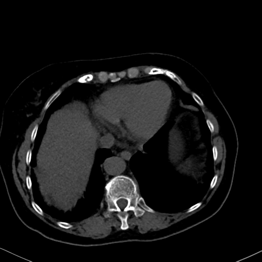 File:Cholecystitis - obstructive choledocholitiasis (CT intravenous cholangiography) (Radiopaedia 43966-47479 Axial 127).png