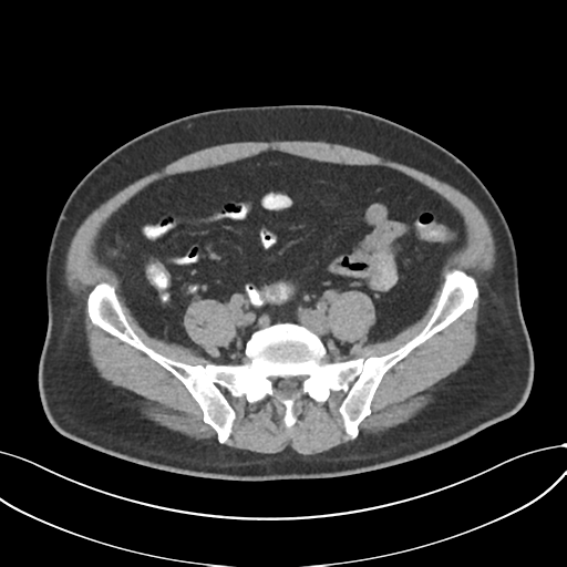 Cholecystitis with focal perforation and hepatic abscess (Radiopaedia 37189-38945 Axial non-contrast 61).png