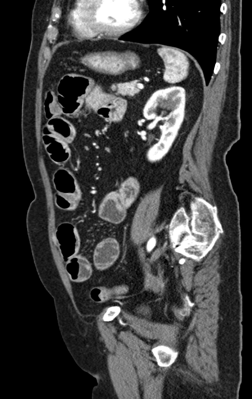Cholecystoduodenal fistula due to calculous cholecystitis with gallstone migration (Radiopaedia 86875-103077 C 21).jpg