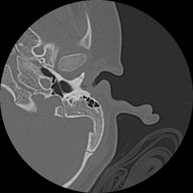 Cholesteatoma (Radiopaedia 73023-83750 Axial Left ear 16).jpg