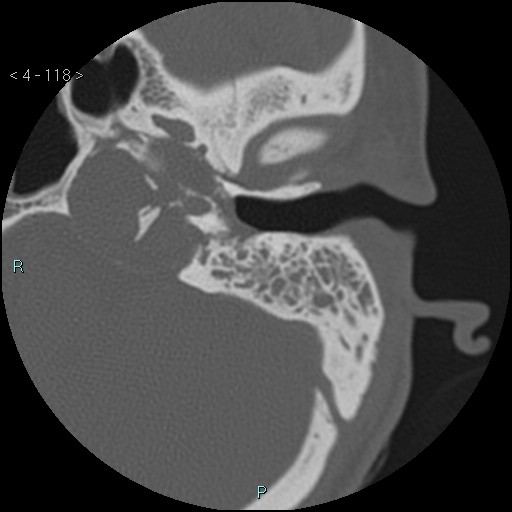 File:Cholesterol granuloma of the petrous apex (Radiopaedia 64358-73141 Axial bone window 57).jpg