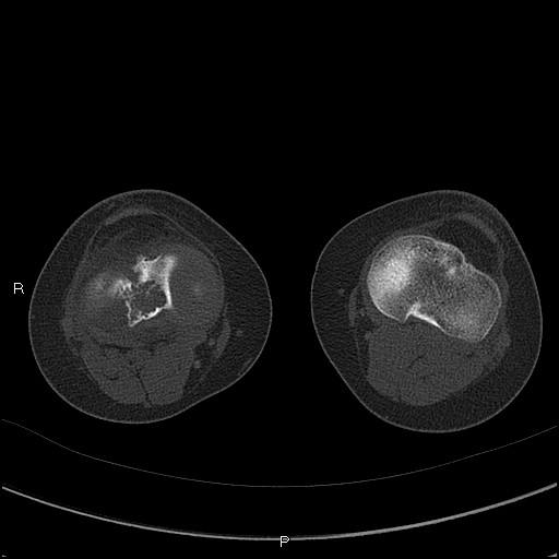 Chondroblastoma (Radiopaedia 62721-71030 Axial bone window 43).jpg