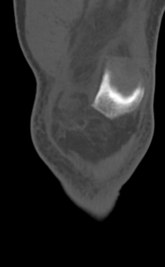 Chondrocalcinosis (Radiopaedia 82862-97173 Coronal bone window 17).jpg