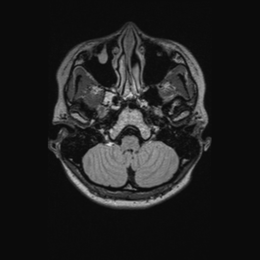 Chondrosarcoma (Radiopaedia 41937-44939 Axial FLAIR 24).png