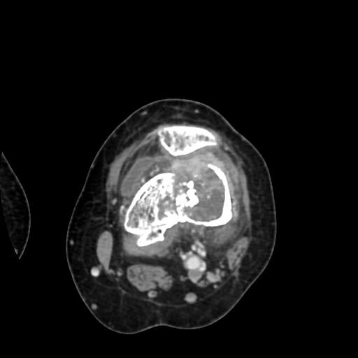 Chondrosarcoma - femur (Radiopaedia 64187-72954 Axial with contrast 38).jpg