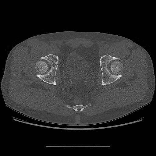 File:Chondrosarcoma of iliac wing (Radiopaedia 63861-72599 Axial bone window 95).jpg