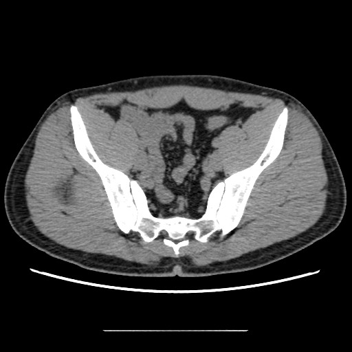 Chondrosarcoma of iliac wing (Radiopaedia 63861-72599 Axial non-contrast 69).jpg