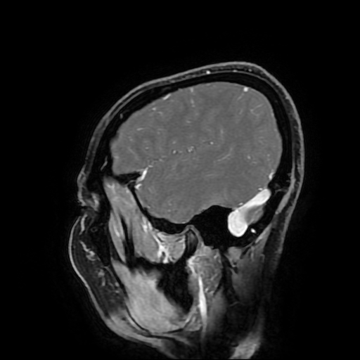 File:Chordoid glioma of third ventricle (Radiopaedia 91612-109340 F 48).jpg