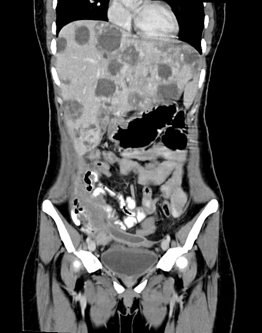 Choriocarcinoma liver metastases (Radiopaedia 74768-85766 B 40).jpg