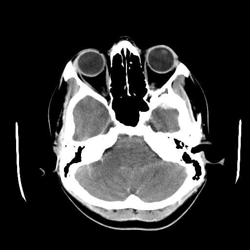 File:Choriocarcinoma of ovary with cerebral and pulmonary metastases (Radiopaedia 25983-26118 A 5).jpg