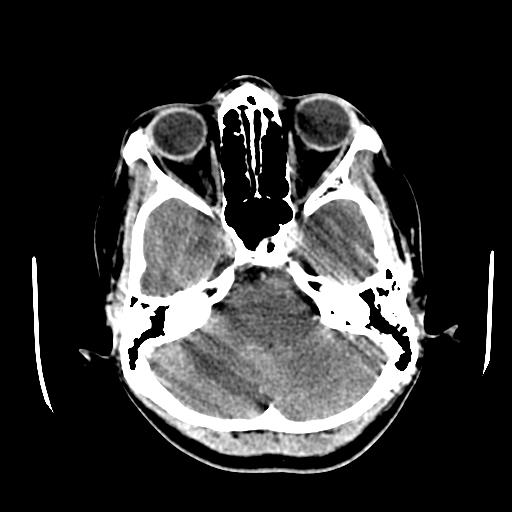 File:Choriocarcinoma of ovary with cerebral and pulmonary metastases (Radiopaedia 25983-26118 C+ arterial phase 33).jpg