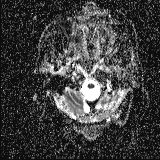 Choroid plexus xanthogranuloma - unilateral (Radiopaedia 85632-101393 Axial ADC 3).jpg