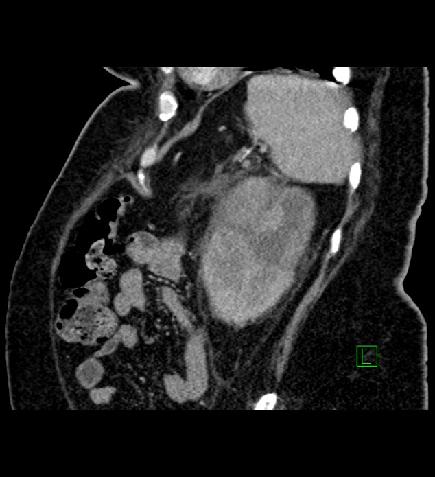 Chromophobe renal cell carcinoma (Radiopaedia 84239-99519 D 27).jpg