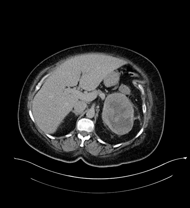 Chromophobe renal cell carcinoma (Radiopaedia 84239-99519 E 58).jpg