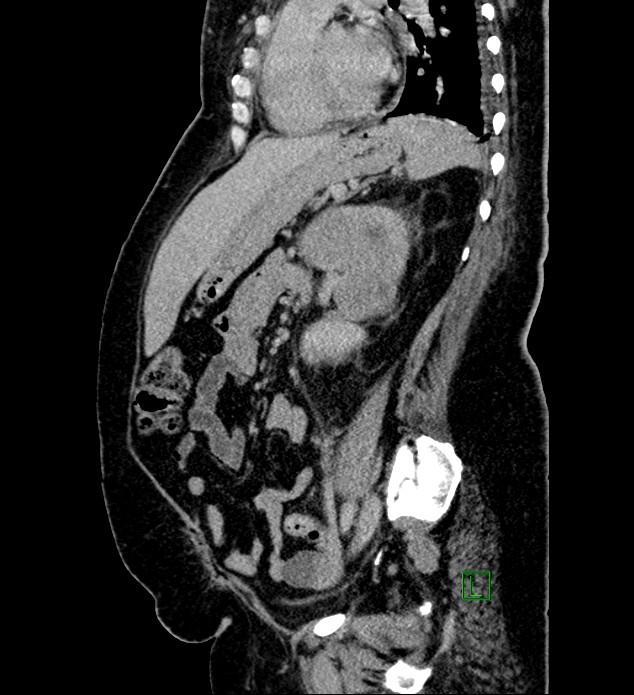 Chromophobe renal cell carcinoma (Radiopaedia 84239-99519 G 46).jpg