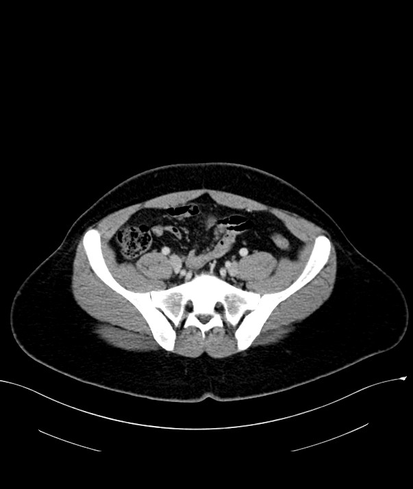 Chromophobe renal cell carcinoma (Radiopaedia 84255-99542 F 63).jpg