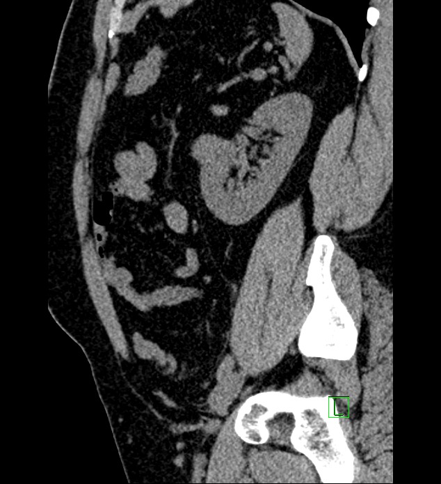 Chromophobe renal cell carcinoma (Radiopaedia 84286-99573 C 50).jpg