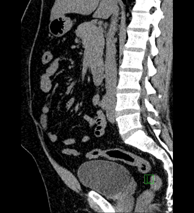 Chromophobe renal cell carcinoma (Radiopaedia 84286-99573 C 94).jpg