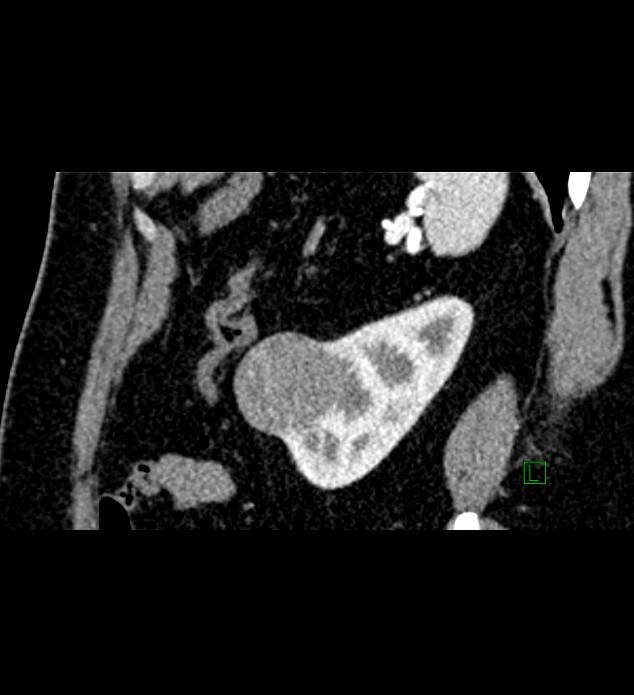 Chromophobe renal cell carcinoma (Radiopaedia 84286-99573 F 35).jpg