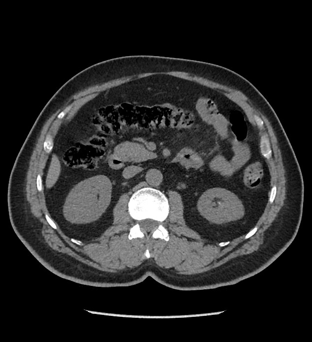 Chromophobe renal cell carcinoma (Radiopaedia 86879-103083 Axial non-contrast 40).jpg