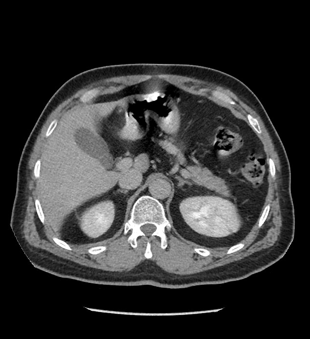 Chromophobe renal cell carcinoma (Radiopaedia 86879-103083 D 37).jpg