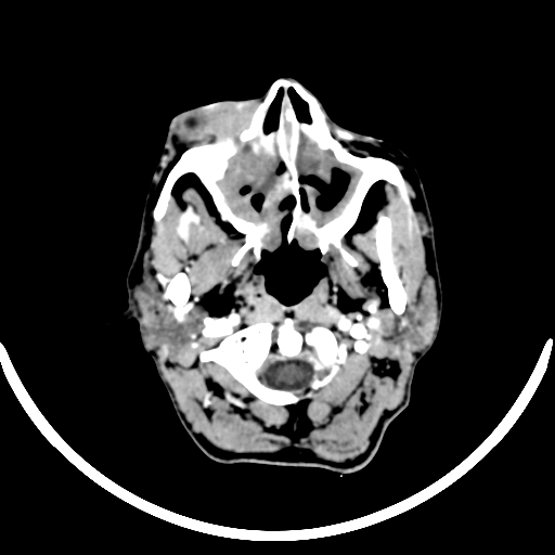 Chronic invasive fungal sinusitis with intraorbital and intracranial extension (Radiopaedia 56387-63046 B 39).jpg