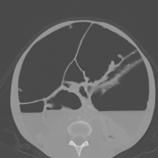 Chronic large bowel pseudo-obstruction (Radiopaedia 43181-46492 Axial bone window 104).jpg