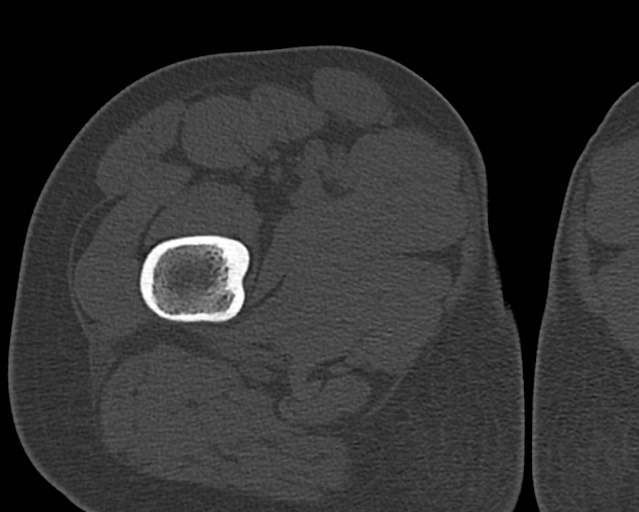 Chronic ostemyelitis of the femur with long sinus tract (Radiopaedia 74947-85982 Axial bone window 32).jpg