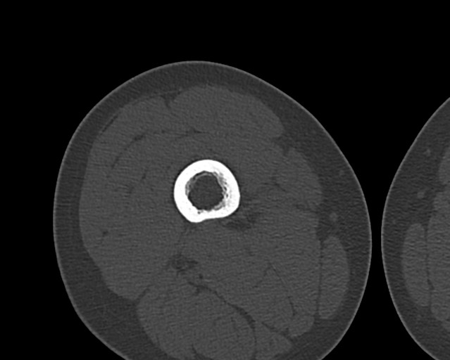 Chronic ostemyelitis of the femur with long sinus tract (Radiopaedia 74947-85982 Axial bone window 85).jpg