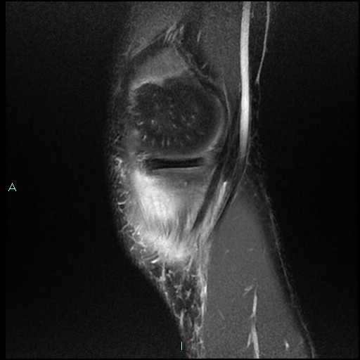 File:Chronic osteomyelitis (with Brodie abscess) (Radiopaedia 76405-88112 Sagittal PD fat sat 3).jpg